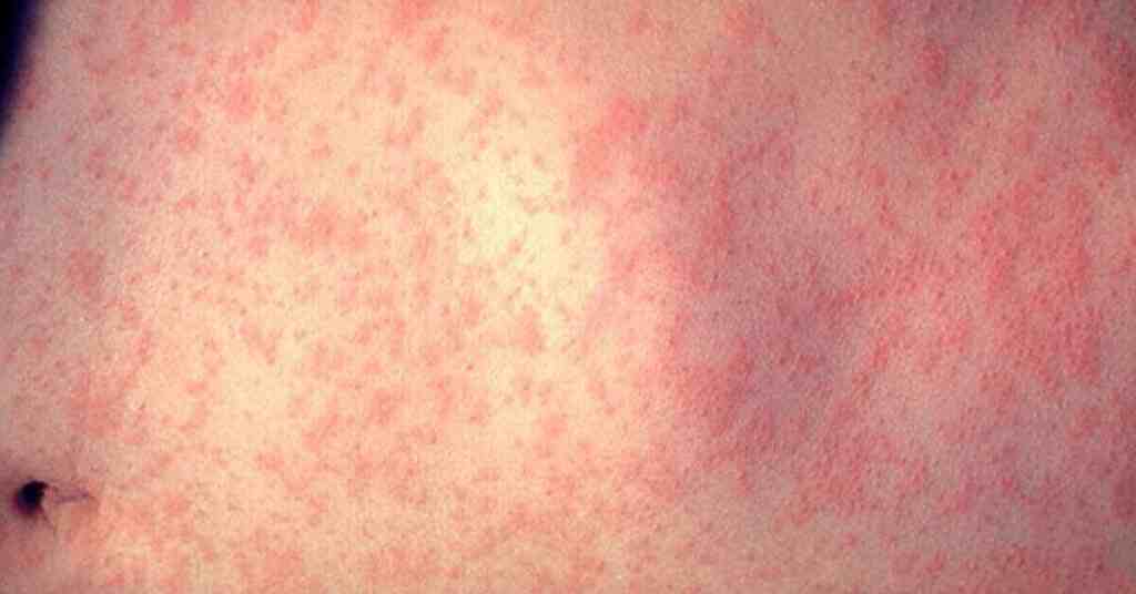 В Україні різко зросла кількість випадків захворювання на кір В Україні різко зросла кількість випадків захворювання на кір